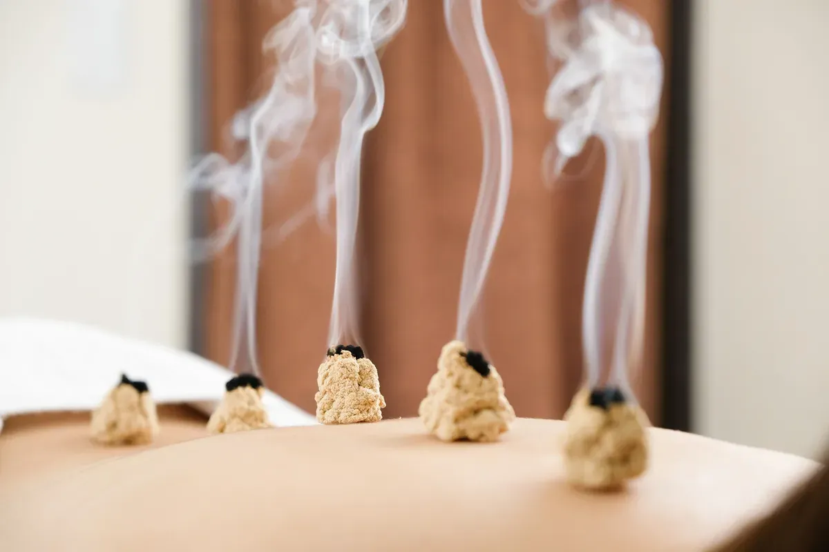 Acupuncture et maux de dos : pourquoi ça fonctionne ?